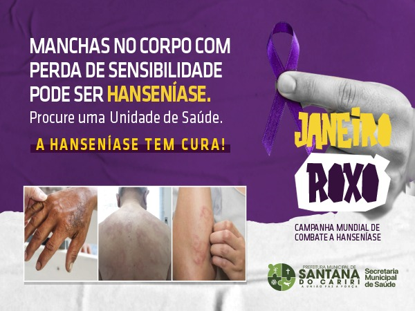 Janeiro Roxo marca o combate à hanseníase - Secretaria da Saúde